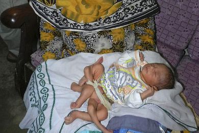 زوجان باكستانيان يرزقان بمولود بـ6 أرجل زوجان باكستانيان يرزقان بمولود بـ6 أرجل